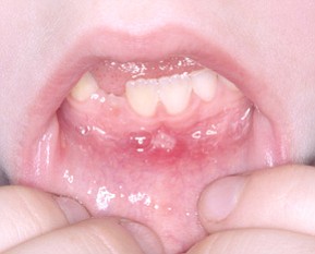 Hand, foot, mouth disease outbreaks require vigilance by parents and ...