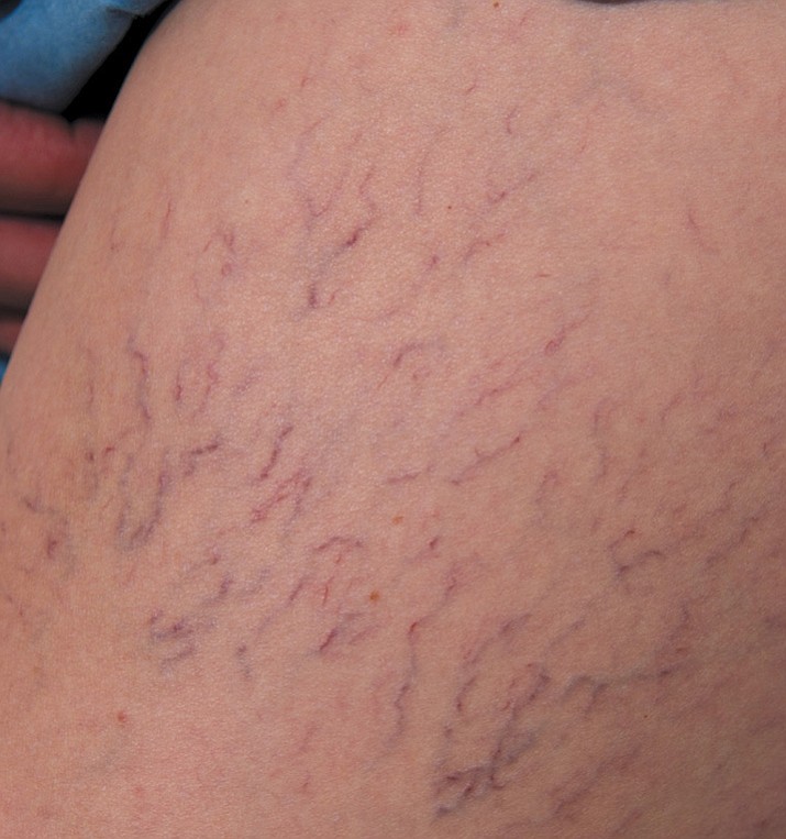 Varicose veins are unsightly but can also be a sign that something is seriously wrong.