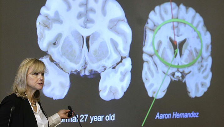 Ann McKee, director Boston University's center for research into the degenerative brain disease chronic traumatic encephalopathy, or CTE, addresses an audience on the school's campus Thursday, Nov. 9, 2017 about the study of NFL football player Aaron Hernandez's brain, projected on a screen, behind right, in Boston.  McKee says Hernandez suffered severe damage to parts of the brain that play an important role in memory, impulse control and behavior.  The cross section of the brain projected behind left is labeled a normal 27 year old.