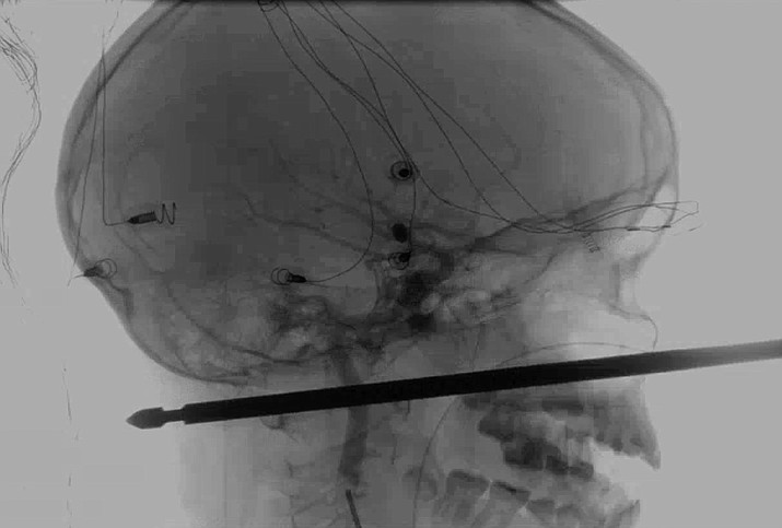 This X-ray provided by the Medical News Network shows a meat skewer impaled in the skull of Xavier Cunningham after an accident at his home Saturday, Sept. 8, 2018, in Harrisonville, Mo. (Medical News Network via AP)