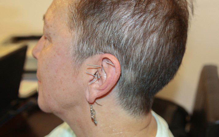 Auricular acupuncture involves five points in the outer ear. (Cronkite News/Tim Royan)