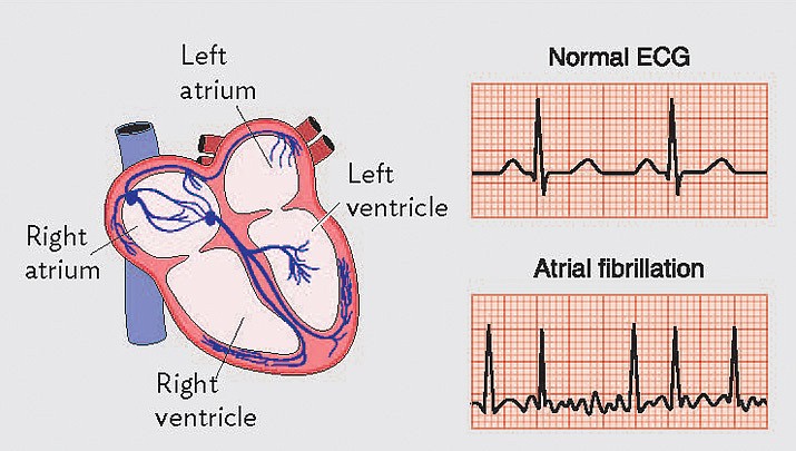 This illustration shows the difference between a normal heart's rhythm and one with atrial fibrillation. (Courier, file)