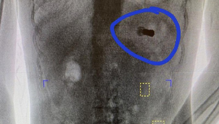 This undated body scan shows an apparent shotgun shell inside the body of a person who was being booked into the lockup. Prisoners entering the Morgan County Jail routinely undergo a body scan when being admitted, and a recent image showed what appeared to be a shell from a .410-gauge shotgun that had been swallowed inside a person, spokesperson Mike Swafford said Thursday, Oct. 21, 2021. (Morgan County Sheriff's Office via AP)