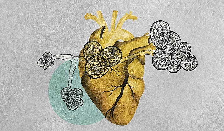 Illustration about the rise of a dangerous fungus called Candida auris.(Illustration/Amelia Bates, Grist via AP)