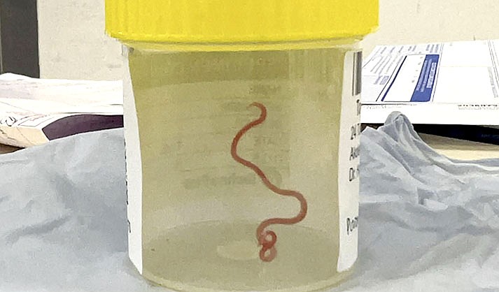 This undated photo, supplied by Canberra Health Services, shows a parasite in a specimen jar at a Canberra hospital in Australia. A neurosurgeon investigating a patient's mystery neurological symptoms in an Australian hospital has been surprised to pluck a 3-inch wriggling worm from her brain. (Canberra Health Services via AP)