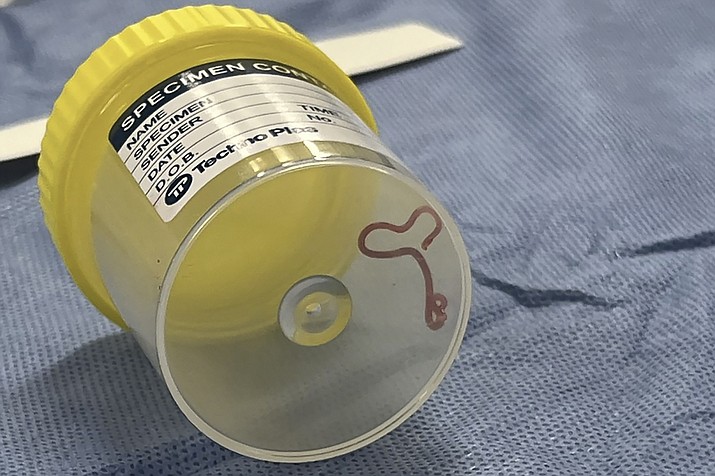 This undated photo supplied by Canberra Health Services, shows a parasite in a specimen jar at a Canberra hospital in Australia. A neurosurgeon investigating a patient’s mystery neurological symptoms in an Australian hospital has been surprised to pluck a 3-inch wriggling worm from her brain. (Canberra Health Services via AP)
